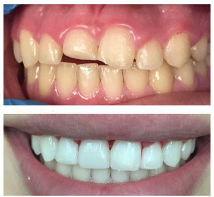 Another case where a patient chipped a tooth and with simple bonding, her smile transformed and bleaching made the smile brighter