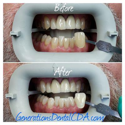 Another great whitening. Even with upper front porcelain to be changed out, the whitening shows good results! GenerationsDentalCDA.com