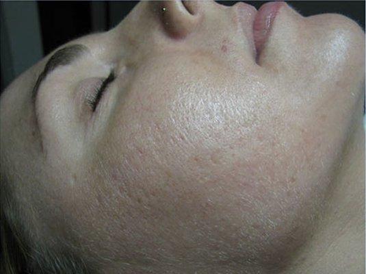 After Treatment from Essentials for Clear Skin - www.essentialsforclearskin.com