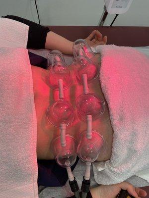 Cupping therapy