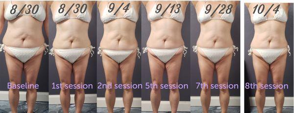 Cavitation (fat reduction) - client after 8 sessions