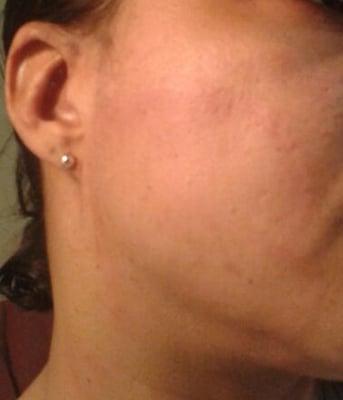 1.5 mths of Rhea Douglas' treatment. I paid this woman, told her what works, and she insists on "practicing" ON MY FACE :'(