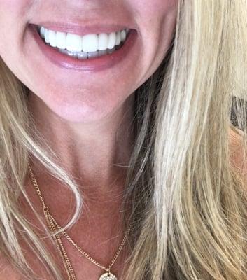 Here is my brand new smile! All porcelain crowns that look beautiful and natural. Thanks Dr. Dillard