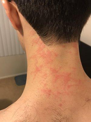 Rash from haircut due to improperly cared for razor.