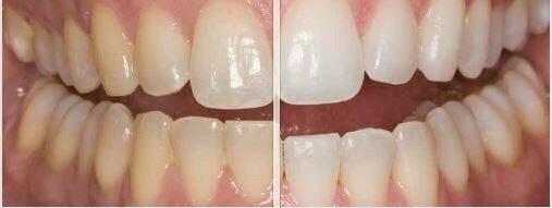 We offer teeth whitening.