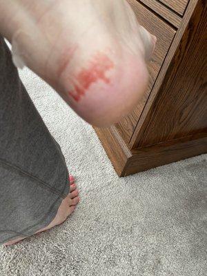 My bloody ankle from Crystal Nail Salon pedicure in Nampa Idaho.