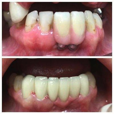 Before and after at NÜVA Smile | Teaneck, NJ