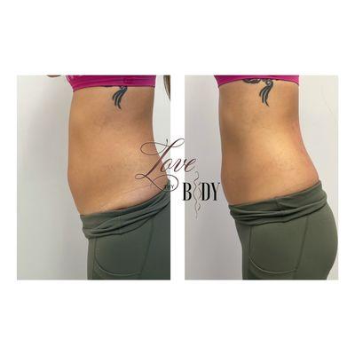 Non-invasive body contouring immediately before & after.