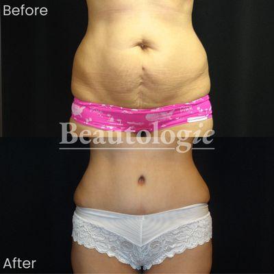 Tummy Tuck Before and After Dr. James Knoetgen