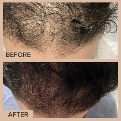 Hair Restoration