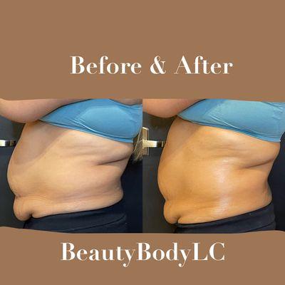 Client booked a lipo cavitation and laser pads session giving her a mixture or both machines to achieve her weight loss goals