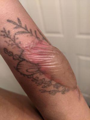 Blister from tattoo removal that kept popping and refilling, very painful