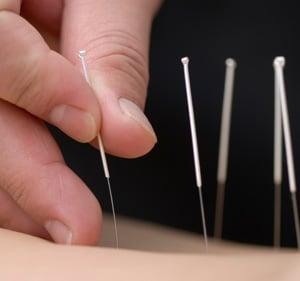 Acupuncture Treatment using acupuncture needles as thin as a hair.