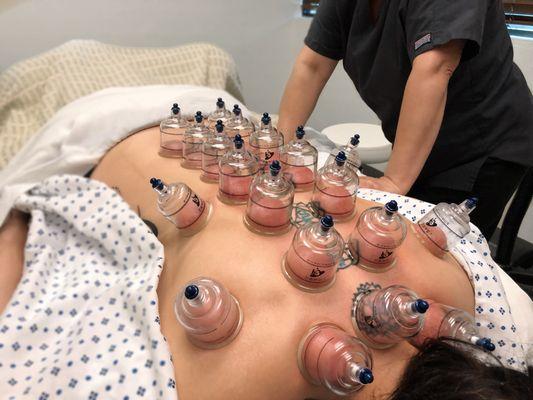 Cupping is for many purposes, including to help with pain, inflammation, blood flow, relaxation and well-being, and deep-tissue massage.