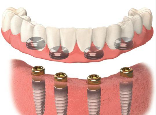 Implant dentist Aston, Brookhaven, Media and Delaware.