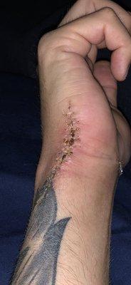 Soon after stitches, still healing.