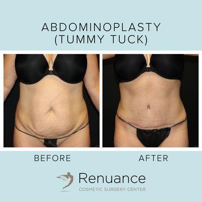 Tummy Tuck at Renuance Cosmetic Surgery Center & Medical Spa in Murrieta, CA