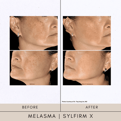 Melasma Sylfirm x