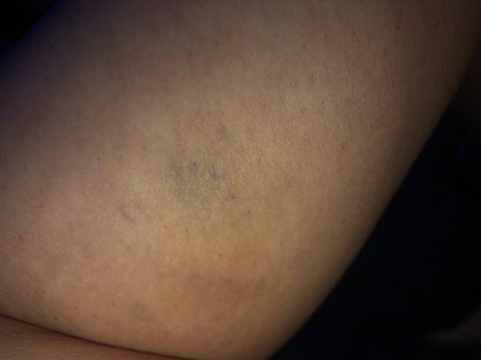 Bruises from massage