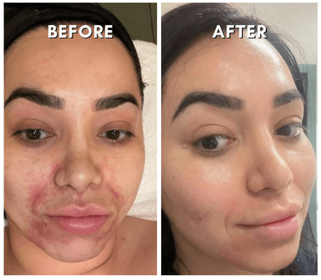 Before and After Microneedling