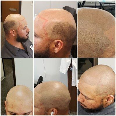 Scalp micropigmentation