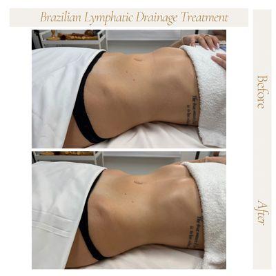 Lymphatic Drainage