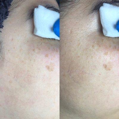 After (left) and before (right) Dermaplaning Facial! Soft supple skin & peach fuzz is removed!