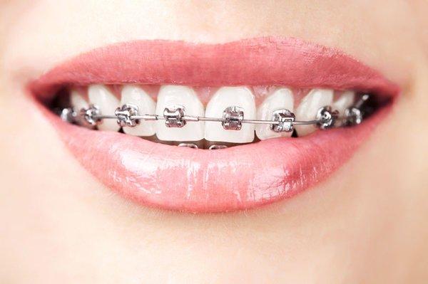 Improve your smile with Braces by Comfy Dental Group and Orthodontics of Simi Valley!