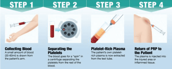 Platelet Rich Plasma Regenerative Medicine