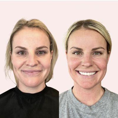 Botox done to reduce the appearance of wrinkles and filler to temples, under eyes, cheeks, lips, and chin to refresh her appearance.