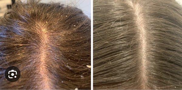 Dandruff removal