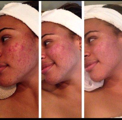 Chemical peels are great for anyone with hyper pigmentation, acne, acne scars, line lines, dark spots, rough skin, shrinks pore size.