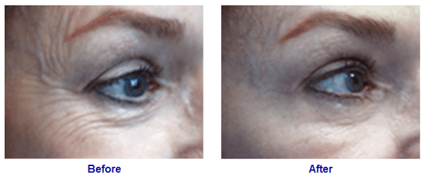 Botox in Palo Alto, Before & After