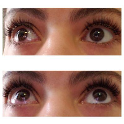 Eye infection caused by poor sanitary conditions and dangerous application of lash extensions.