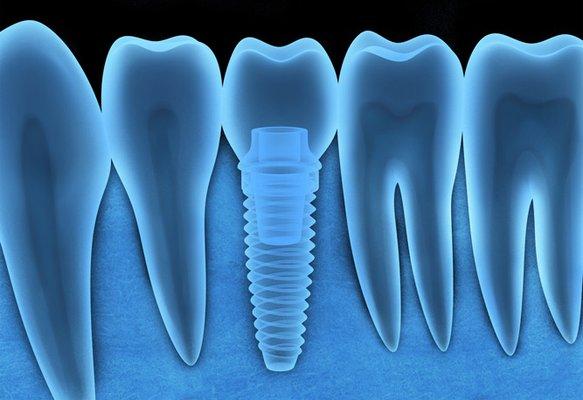 Best way to restore missing tooth - Implant