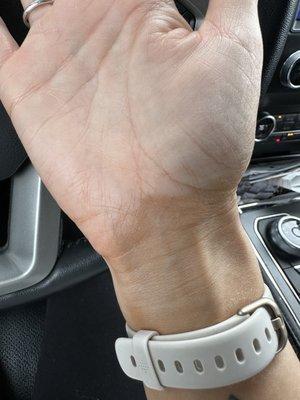 My wrist after following the directions to a tee.