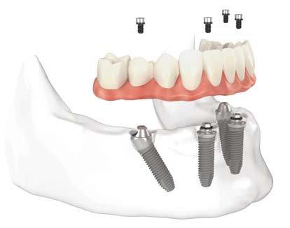 "All on 4" Implant supported