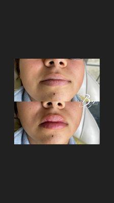 Before & after Hyaluron pen lip filler