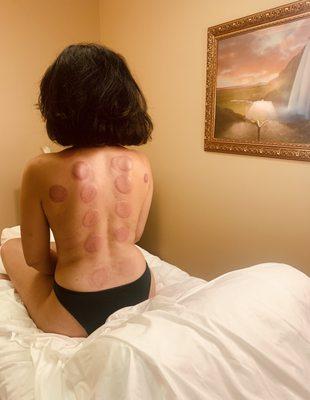 Cupping for women's health