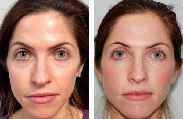 Botox and Juvederm