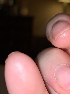 Pinky nail with split down the middle/ nail splinter hemorrhages