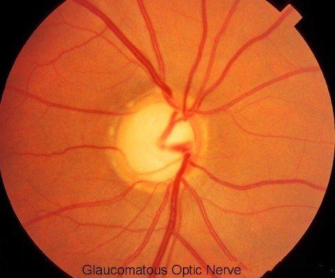 Glaucoma diagnosed & treated at Master Eye Associates.