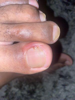 My Big toe that got cut and infected from the unsafe sanitation practices