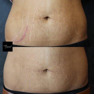 before and after using inkless ink to blend this lovely clients stretch marks into her skin