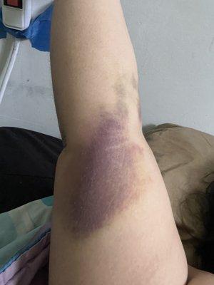 Bruises