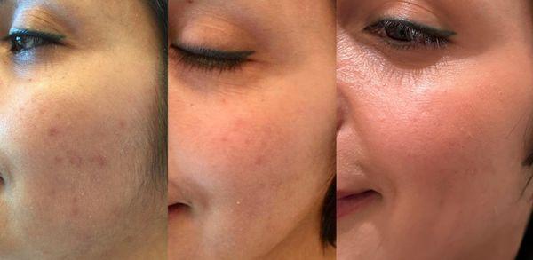 Active acne treatment & skin resurfacing laser.