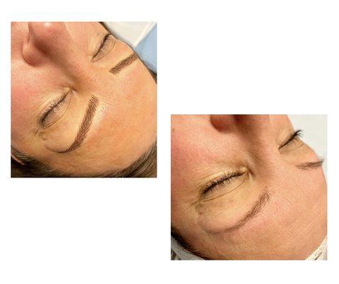 Microblading