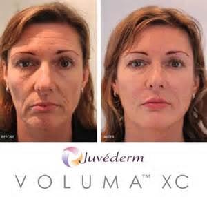 Voluma XC for Cheek Augmentation Before & After