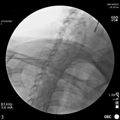 Our client's persistent neck symptoms prompted a Cervical steroid injection by fluoroscopic guidance.