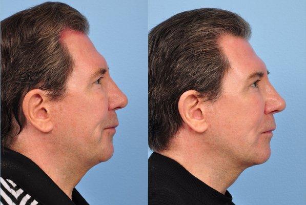 Non-surgical reduction of chin fullness